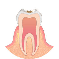 歯の表面に虫歯ができます