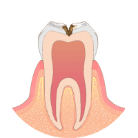 虫歯が神経に近くなり、冷たいものがしみます