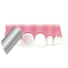 歯の表面をツルツルに仕上げ磨き
